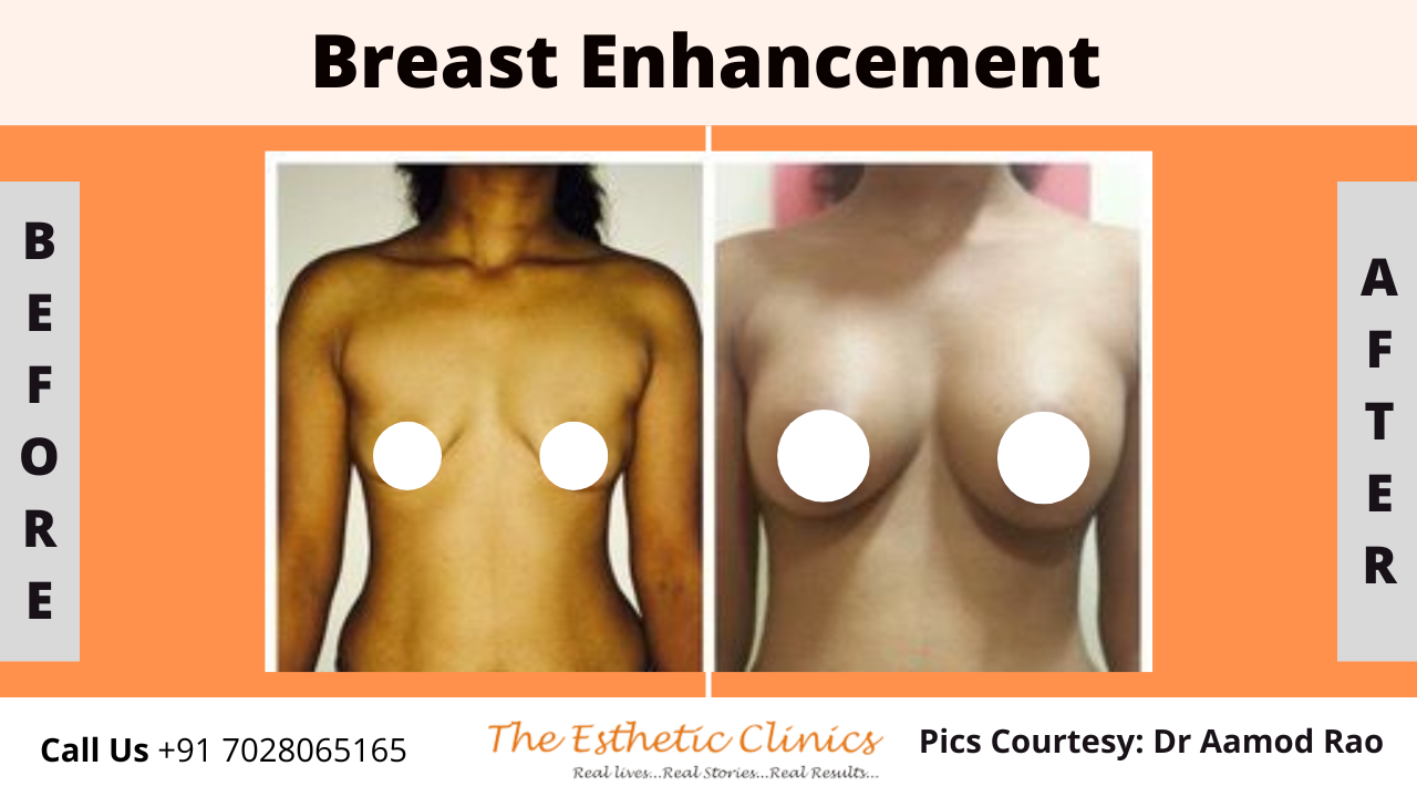 Best Body Contouring Surgery Treatment before after photos in Mumbai, India