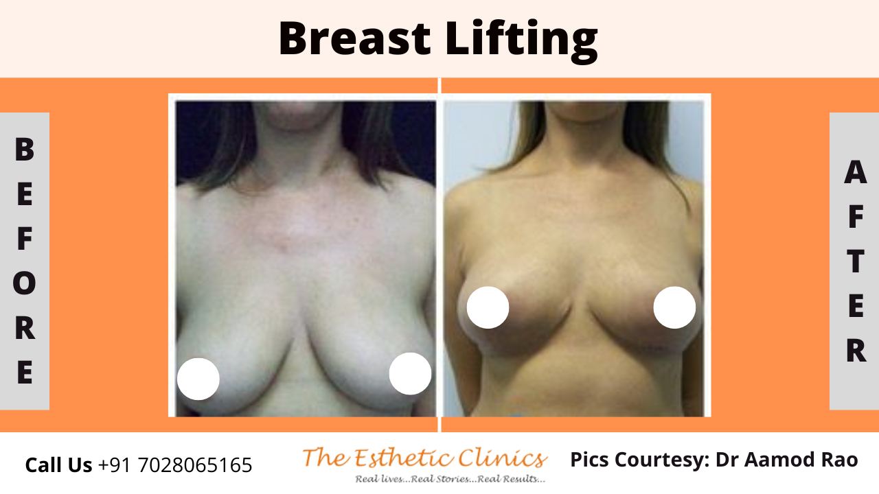 Best Body Contouring Surgery Treatment before after photos in Mumbai, India