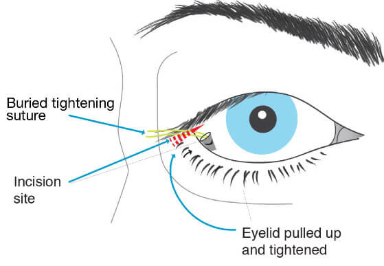 Best Eyelid Ptosis Surgery in Mumbai, Eyelid Treatment at Affordable Price Cost India by Dr Debraj Shome at The Esthetic Clinics