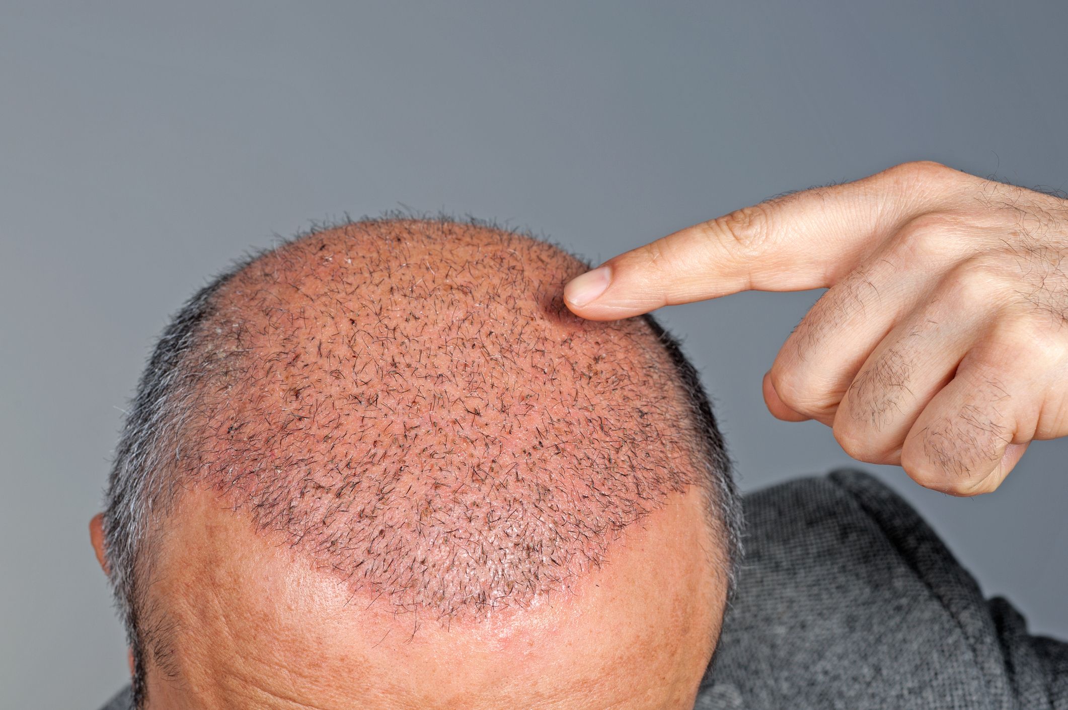 Best hair Transplant Treatment in Mumbai, Hair Treatment at Affordable Price Cost India by Dr Debraj Shome at The Esthetic Clinics Best hair Transplant Treatment in Mumbai, Hair Treatment at Affordable Price Cost India by Dr Debraj Shome at The Esthetic Clinics