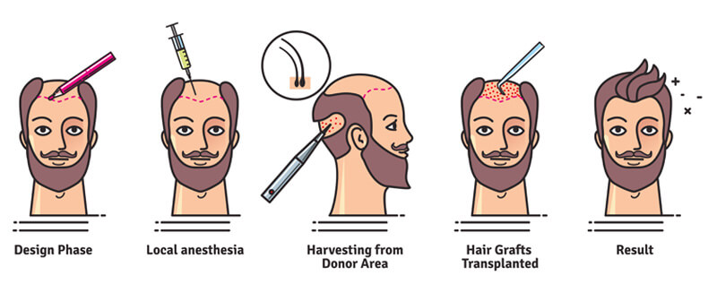 Best hair Transplant Treatment in Mumbai, Hair Treatment at Affordable Price Cost India by Dr Debraj Shome at The Esthetic Clinics Best hair Transplant Treatment in Mumbai, Hair Treatment at Affordable Price Cost India by Dr Debraj Shome at The Esthetic Clinics
