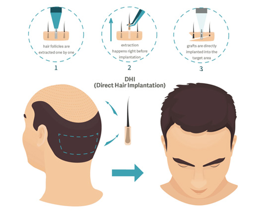 Best hair Transplant Treatment in Mumbai, Hair Treatment at Affordable Price Cost India by Dr Debraj Shome at The Esthetic Clinics Best hair Transplant Treatment in Mumbai, Hair Treatment at Affordable Price Cost India by Dr Debraj Shome at The Esthetic Clinics