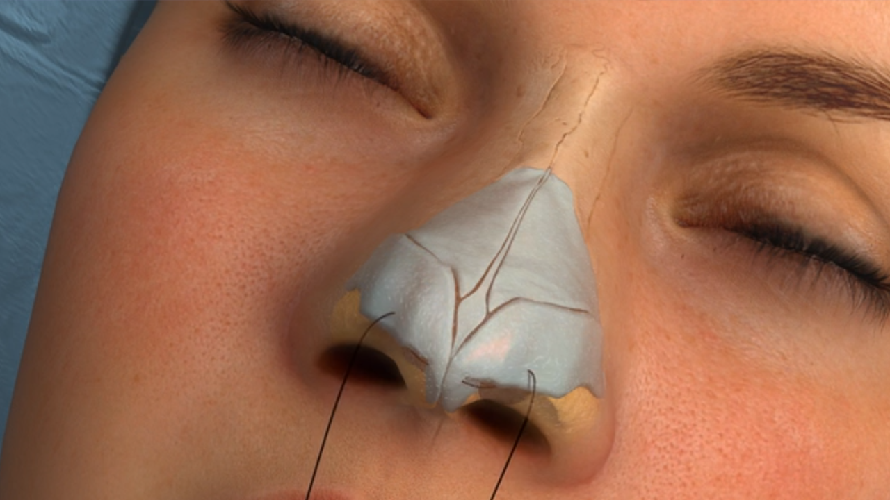 Best Rhinoplasty Surgery in Mumbai, Nose Treatment at Affordable Price Cost India by Dr Debraj Shome at The Esthetic Clinics