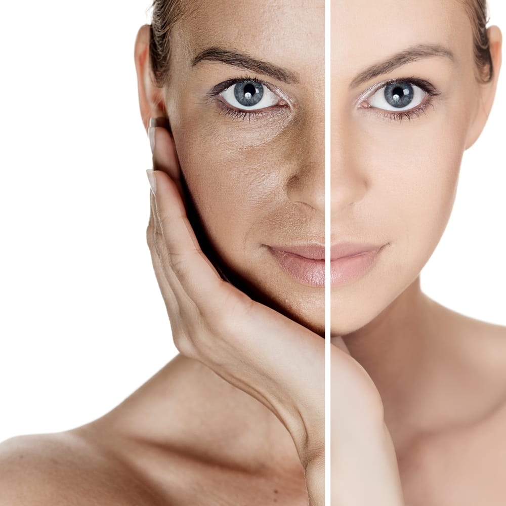 Best Face Skin Pigmentation Treatment in Mumbai at Affordable Price Cost India by Dr Rinky Kapoor at The Esthetic Clinics