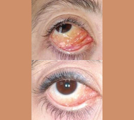 Microdermabrasion Treatment