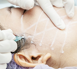 Face threads