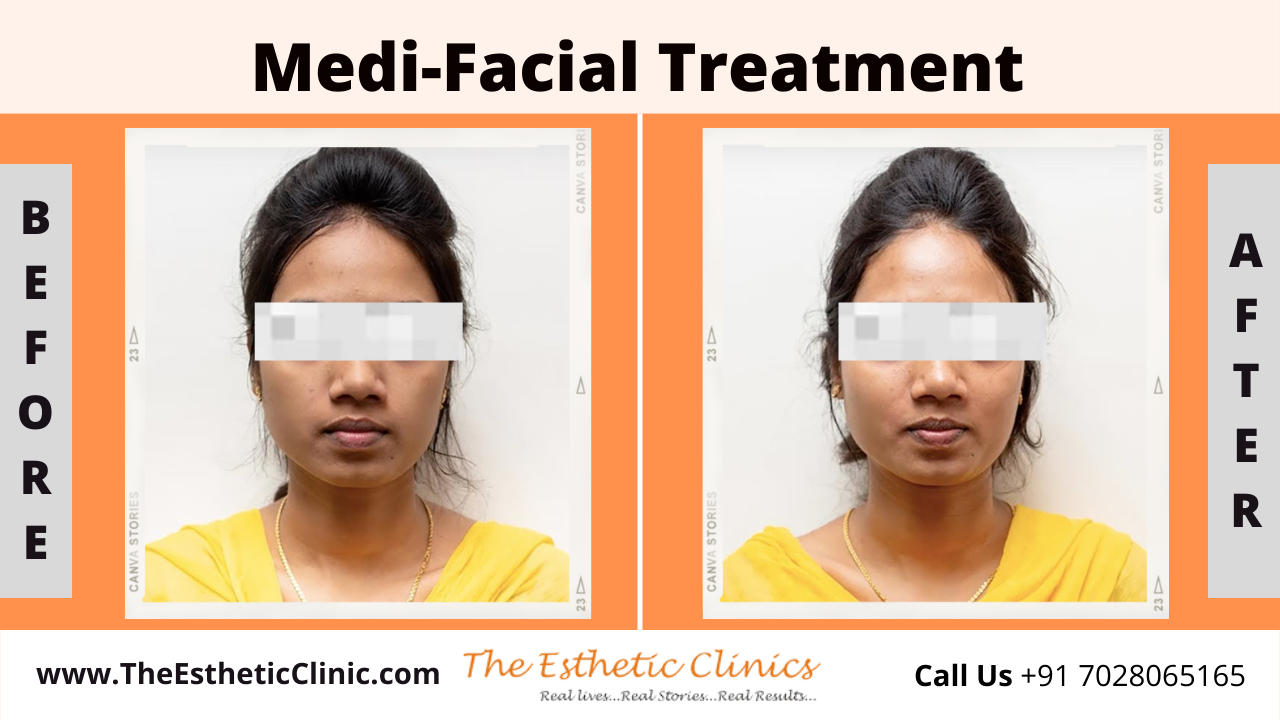 Medi-Facial Treatment before after photos in mumbai india