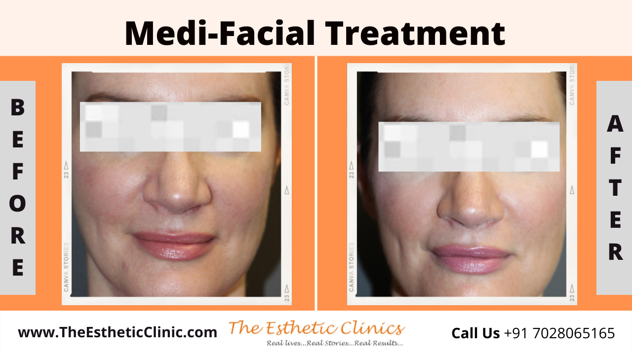 Medi-Facial Treatment before after photos in mumbai india