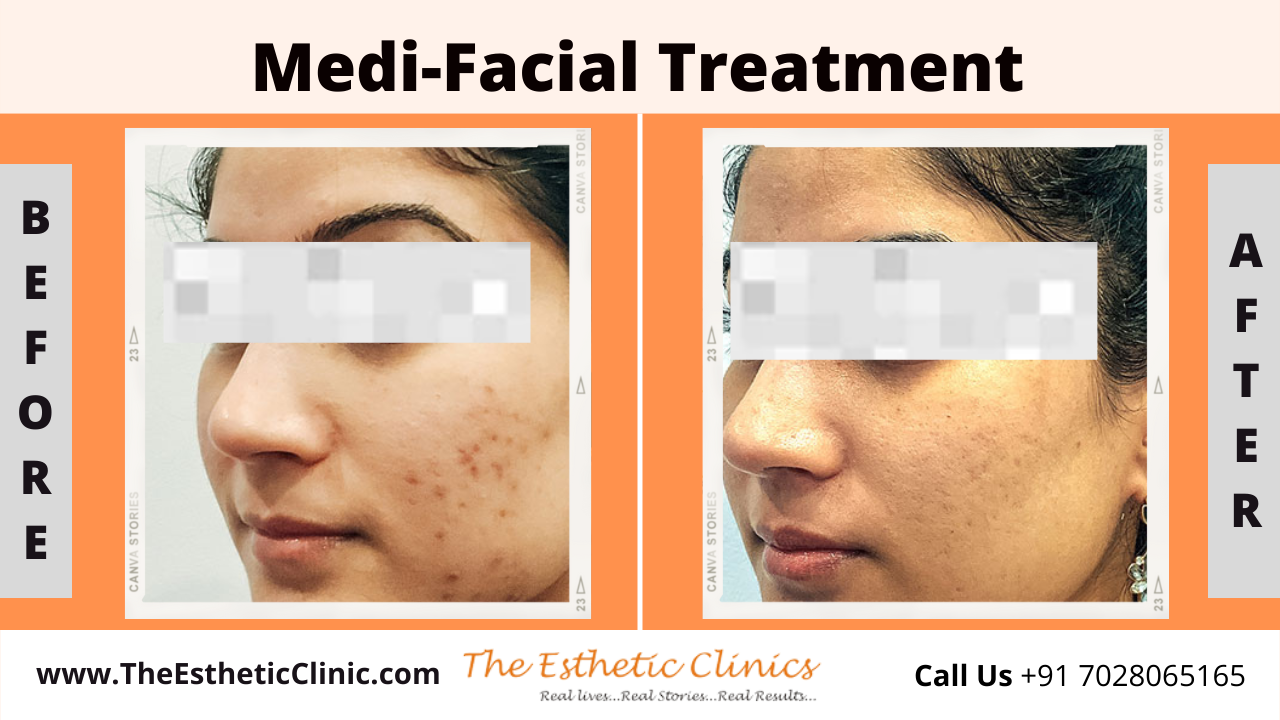 Medi-Facial Treatment before after photos in mumbai india