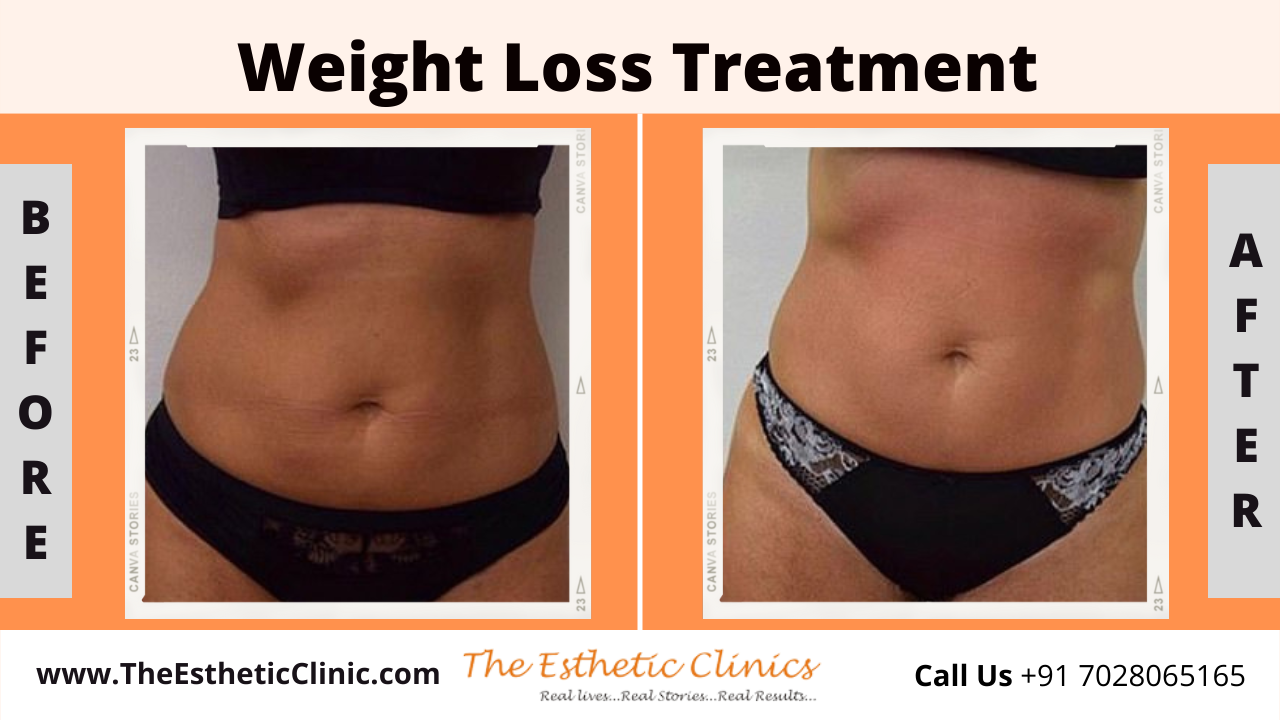 Non-Surical Weight Loss Treatment before after photos in mumbai india