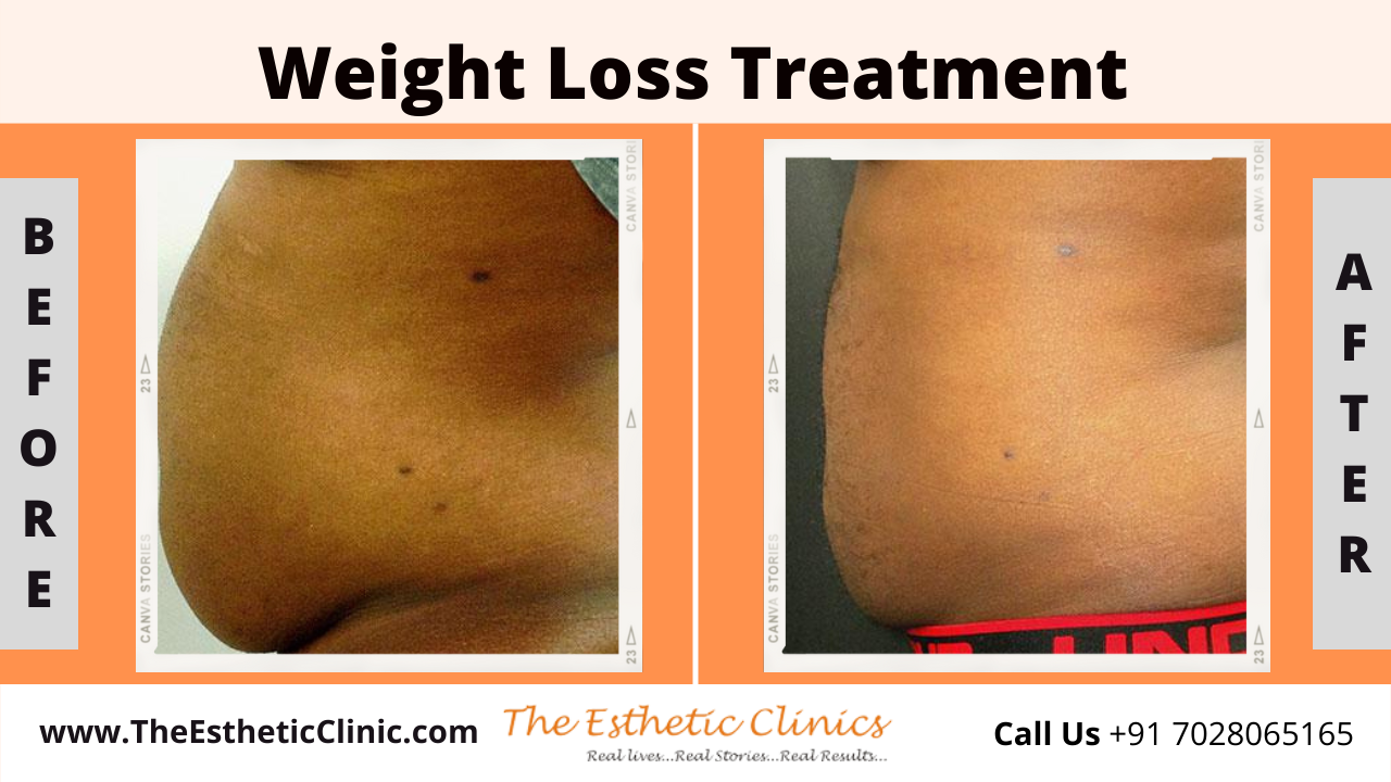 Non-Surical Weight Loss Treatment before after photos in mumbai india