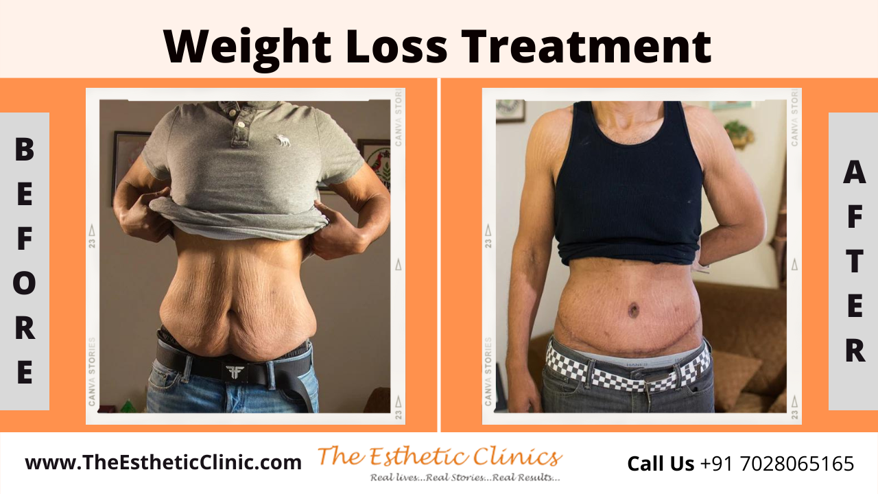 Non-Surical Weight Loss Treatment before after photos in mumbai india