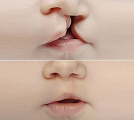 Cleft Lip