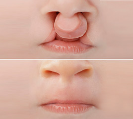 Cleft Palate