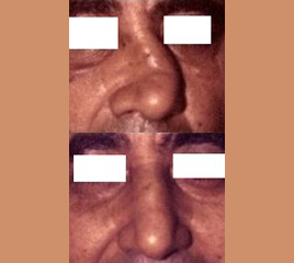 Retinal Tumour