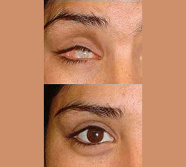 False Eye