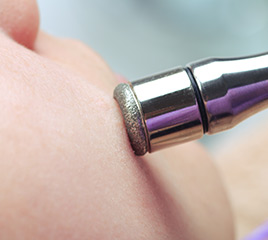 Microdermabrasion Treatment