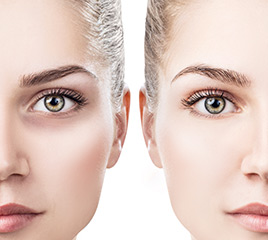 Dark Circles Treatment