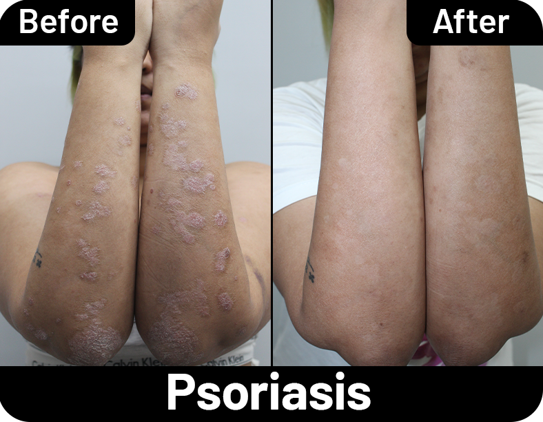 Psoriasis